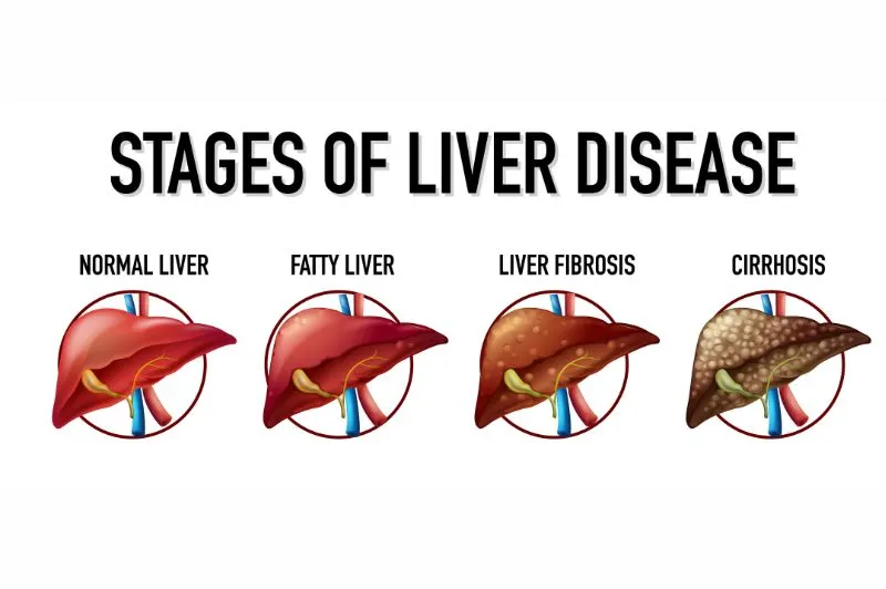 Stage 4 Liver Cancer How Long to Live | The Health Place